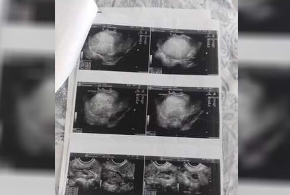 Paciente com sangramento há 40 dias denuncia atendimento na Maternidade de Roraima