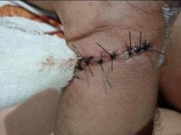 Com cinco meses de espera por cirurgia em RR, paciente denuncia saúde estadual por negliência