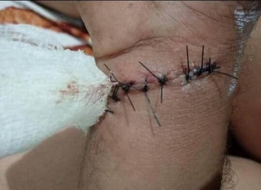 Com cinco meses de espera por cirurgia em RR, paciente denuncia saúde estadual por negliência